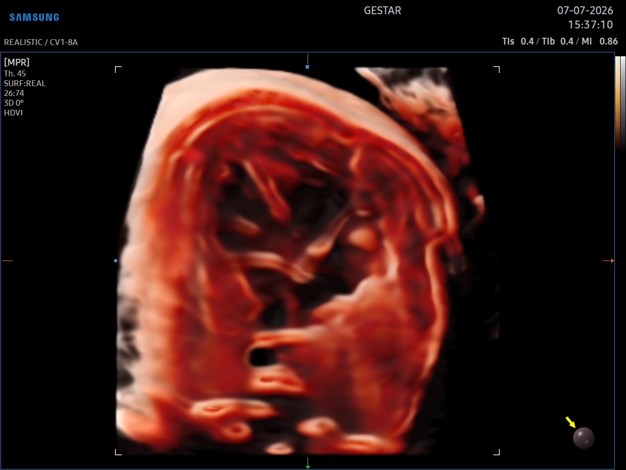 Ecocardiografia Fetal