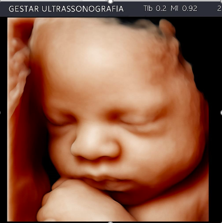 Ultrassom 3D / 4D